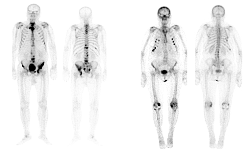Przykładowe scyntygramy układu kostnego.